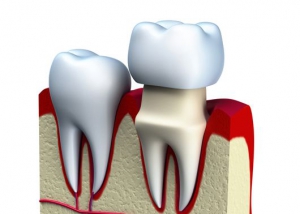 Candidates for dental crowns