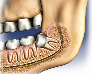 Complications of tooth extraction