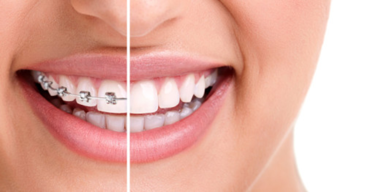 Important Things to Know Before You Get Dental Braces Dreamworks