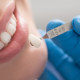 Things You Need to Know About Dental Crowns