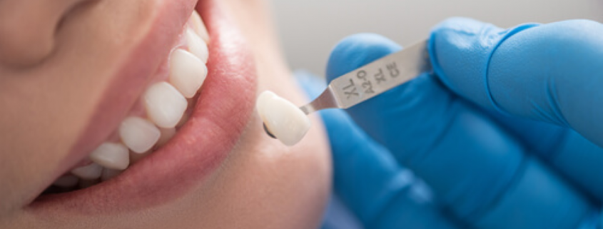 Things You Need to Know About Dental Crowns