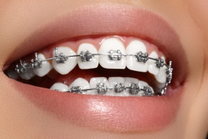Types of braces
