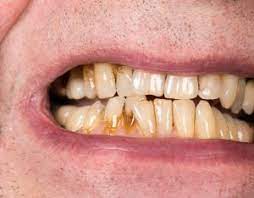 Types of teeth stains