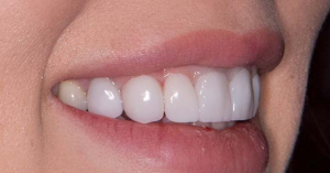 What are Dental Veneers