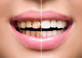 What are the benefits of dental veneers?