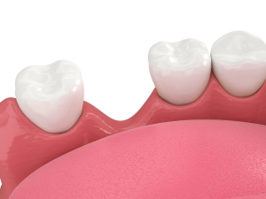 What is a dental crown?