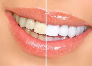 Who should get their teeth whitened?