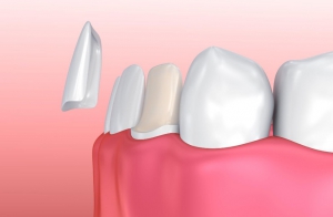 What are the different types of veneers?